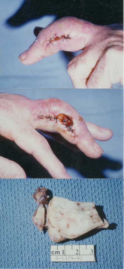 Finger Nodules